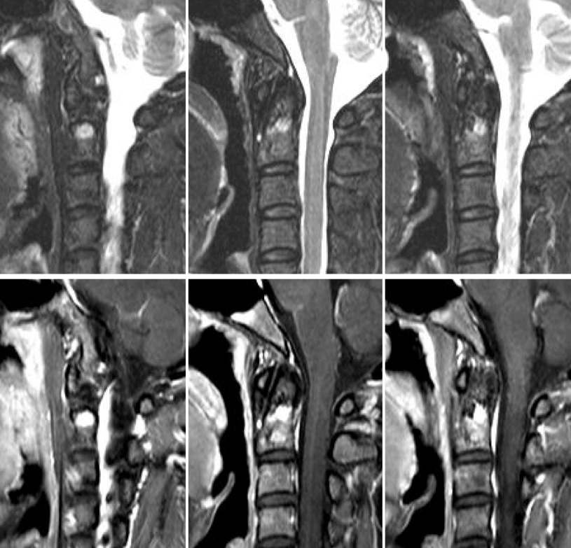 Figure 4 for case fibrous dysplasia ( RID3738 )
